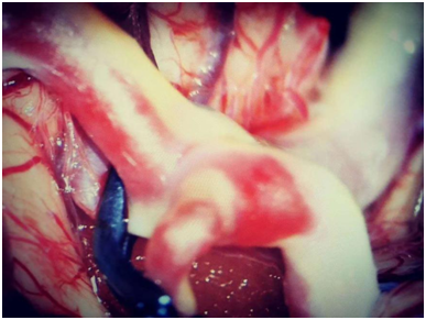 動脈瘤夾閉術后