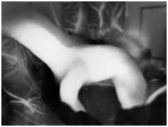 在熒光造影下評估動脈瘤夾閉后情況